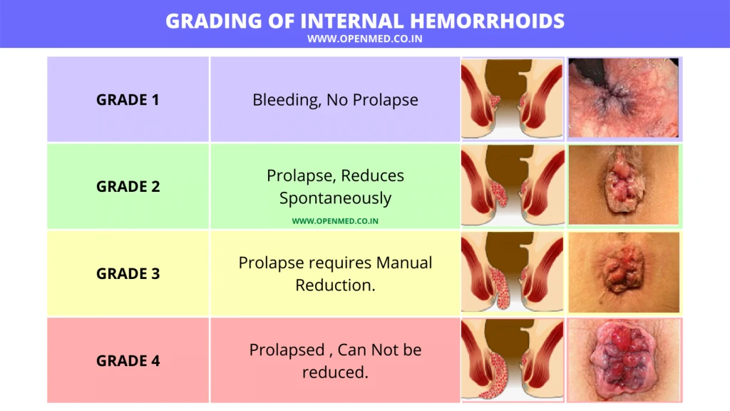 Stages and grading of hemorrhoids