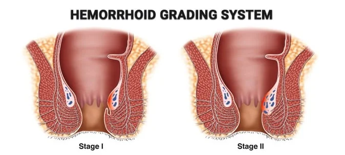 Hemorrhoids laser treatment - hemorrhoid grading systema