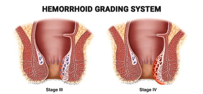Hemorrhoids laser treatment - hemorrhoid grading systemb