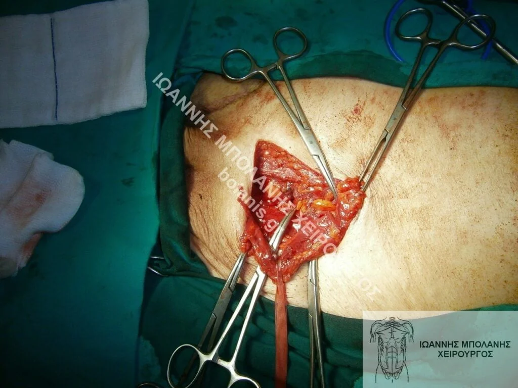 Hernia repair - hernia signed 1
