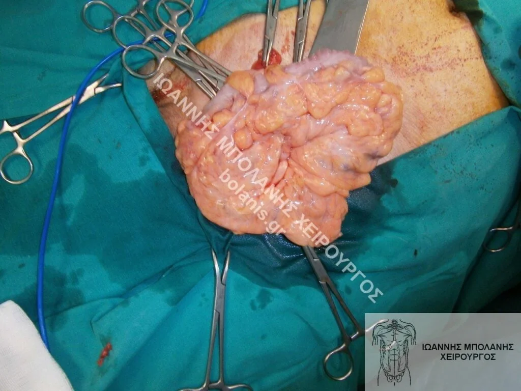 Hernia repair - hernia signed 2