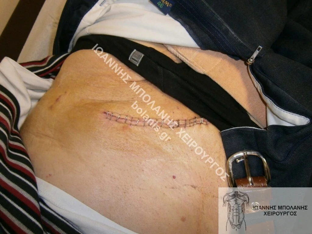 Hernia repair - hernia signed 3