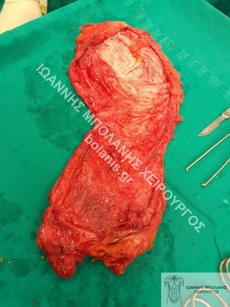 postoperative hernia
