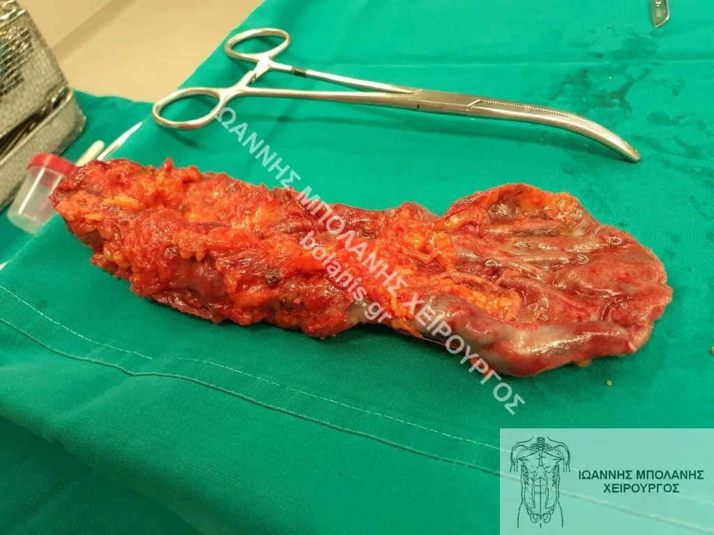 postoperative hernia