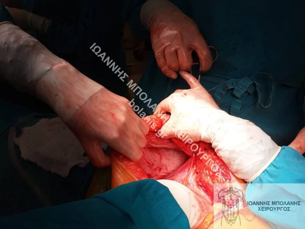 postoperative hernia