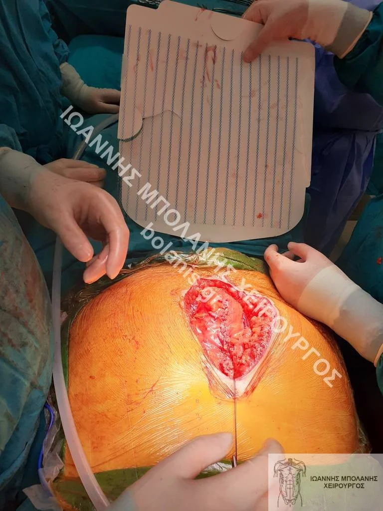 postoperative hernia