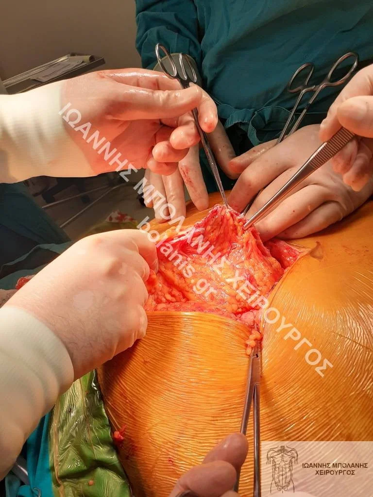 postoperative hernia