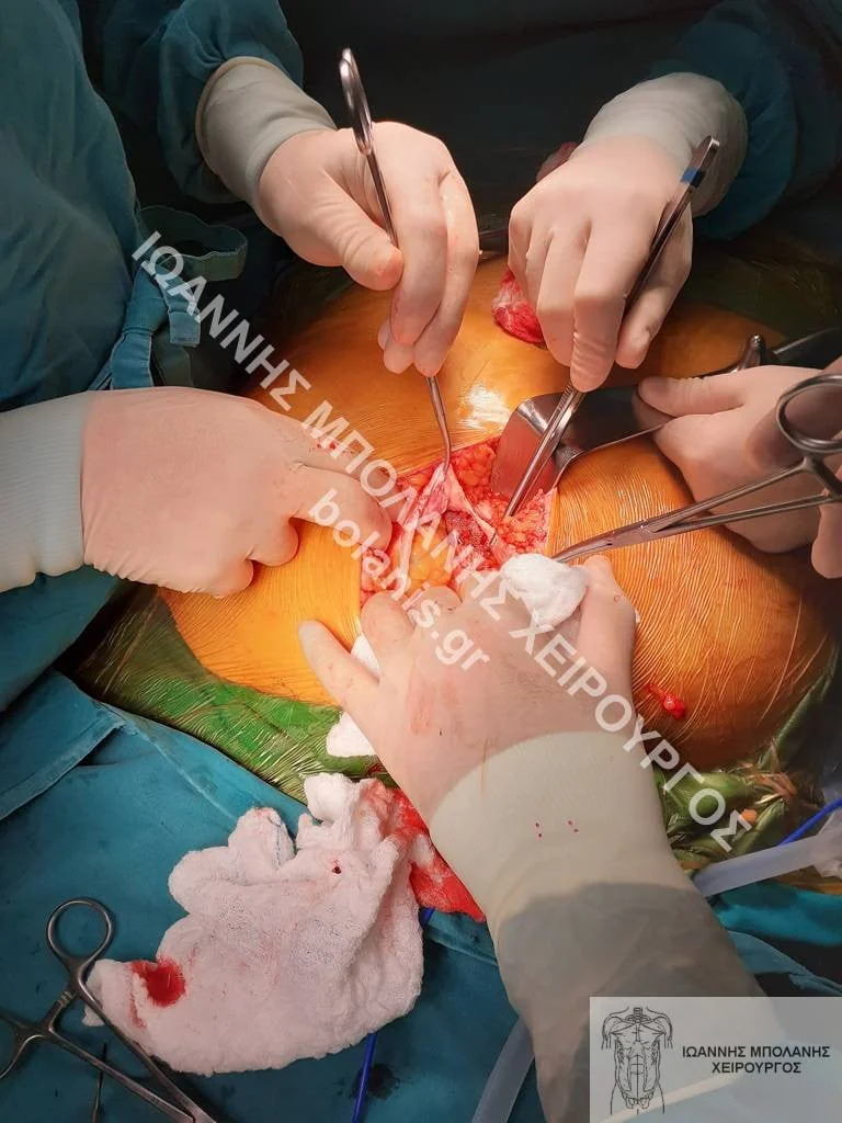 postoperative hernia