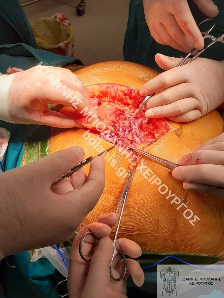 postoperative hernia