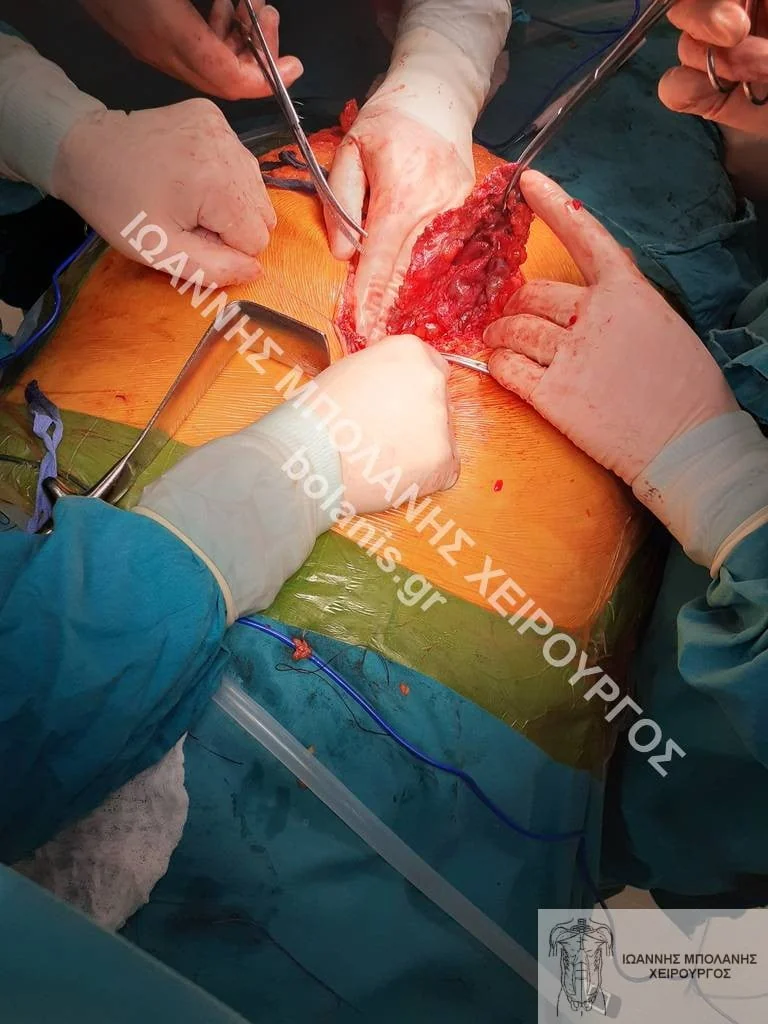 postoperative hernia
