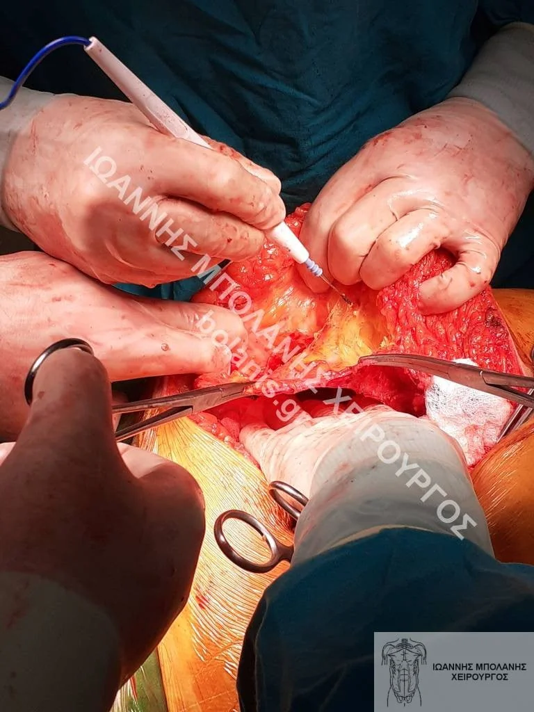 postoperative hernia