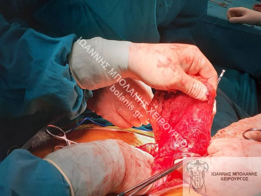 postoperative hernia