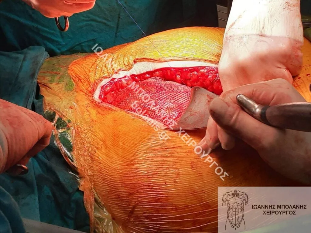 postoperative hernia