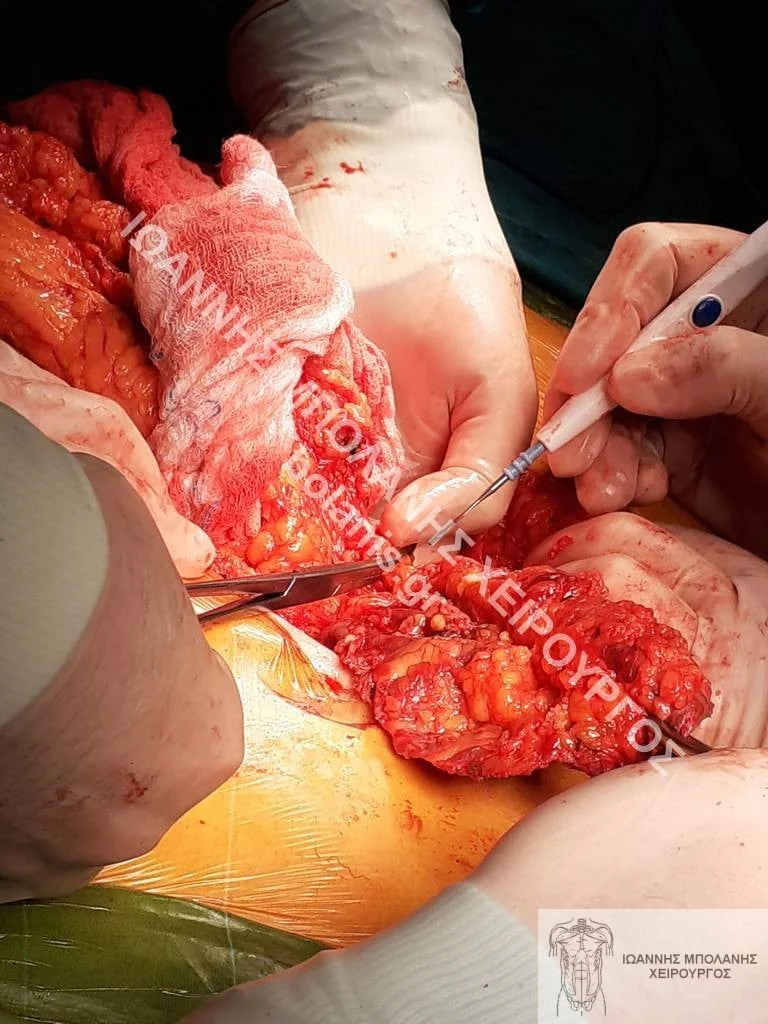 postoperative hernia