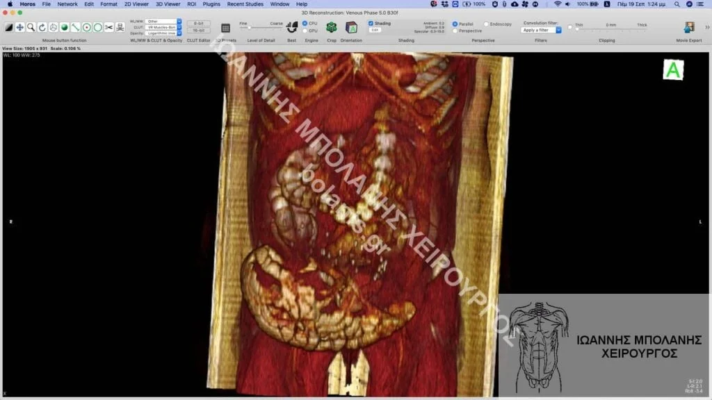 postoperative hernia