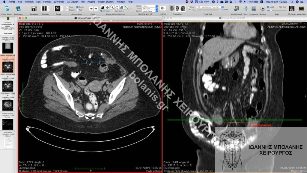 postoperative hernia