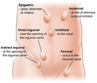  Hernias & Hernias