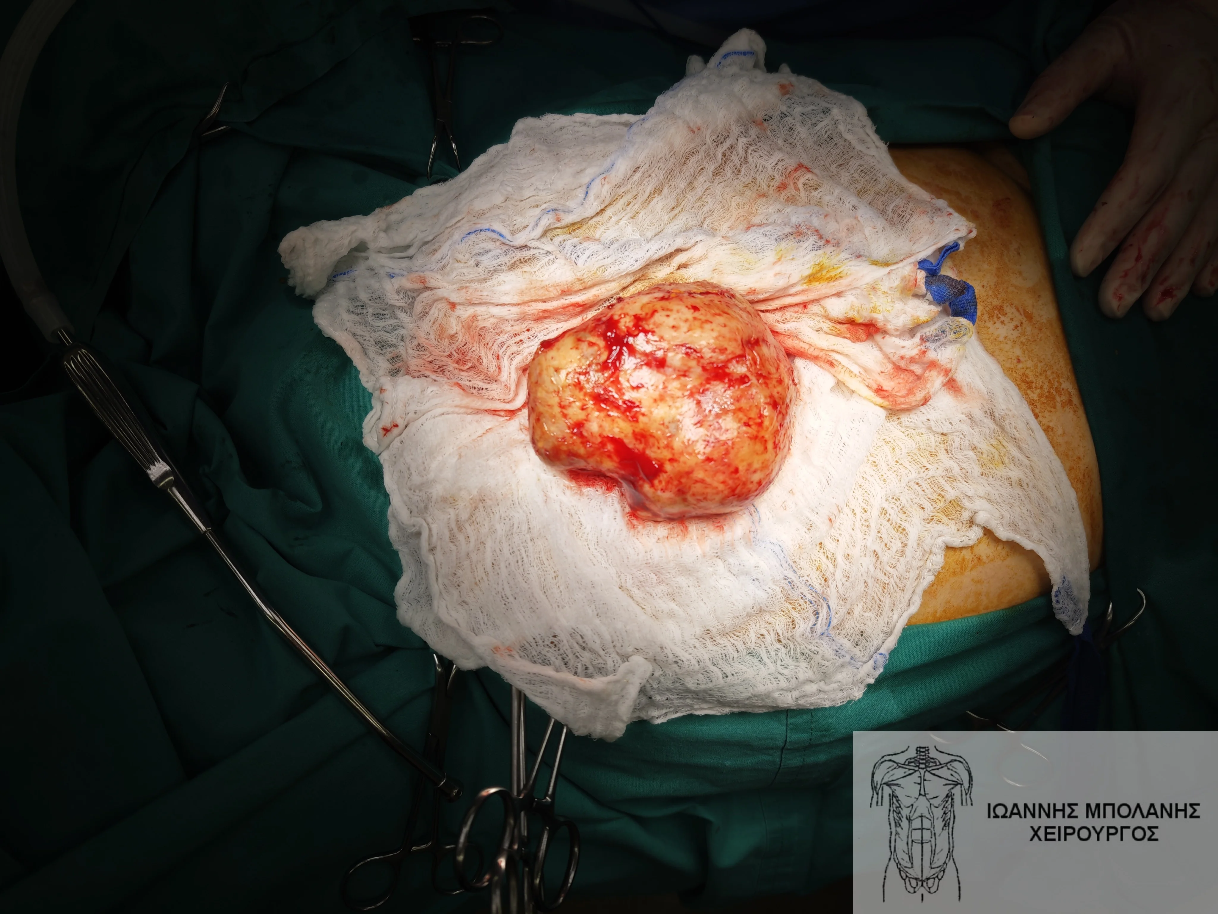 Gastrointestinal GIST stromal tumor, symptoms treatment prognosis