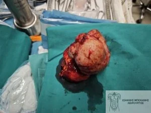 GIST stromal tumor