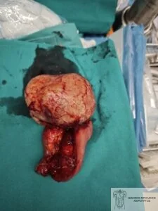 GIST stromal tumor