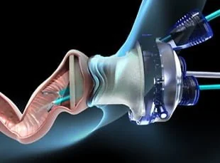 Transanal endoscopic surgery