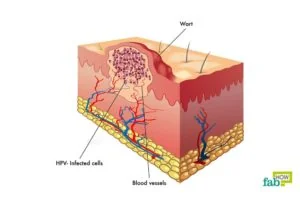 Anal warts