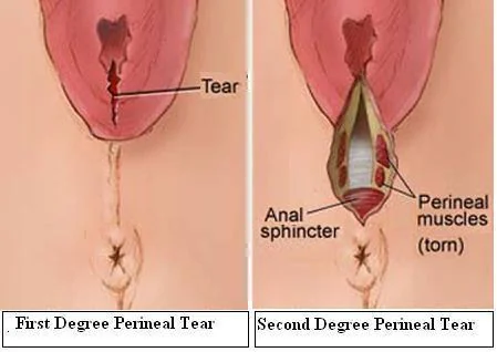 Sphincter damage fecal incontinence 1-2
