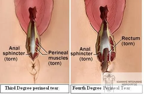 Sphincter damage fecal incontinence 3-4