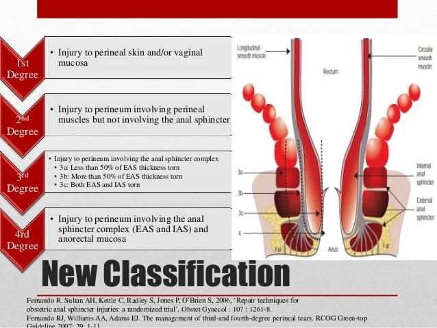 Sphincter damage fecal incontinence