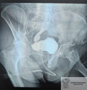 Rectal cancer without colostomy - rectal cancer 2