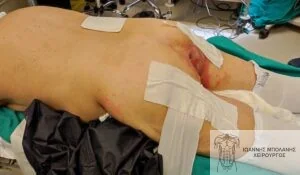 FiLaC® laser periosteal fistula - rectal cancer fistula 3