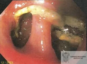 FiLaC® laser periosteal fistula - rectal cancer fistula 4