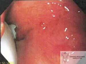 FiLaC® laser periosteal fistula - rectal fistula cancer 5