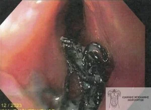 FiLaC® laser periosteal fistula - rectal fistula cancer 6