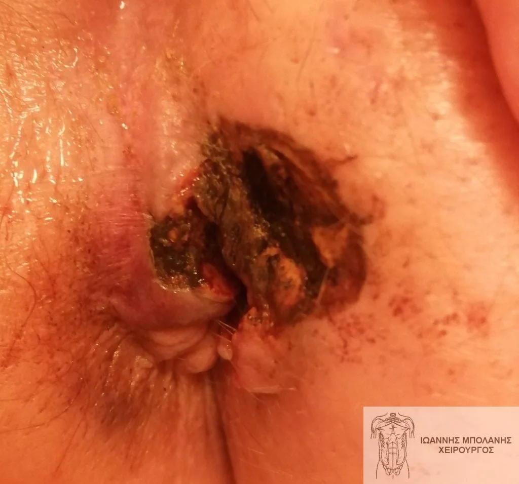 Anal cancer, what not to do! - Dr. Ioannis Bolanis – Colorectal Surgeon - rectal cancer 2