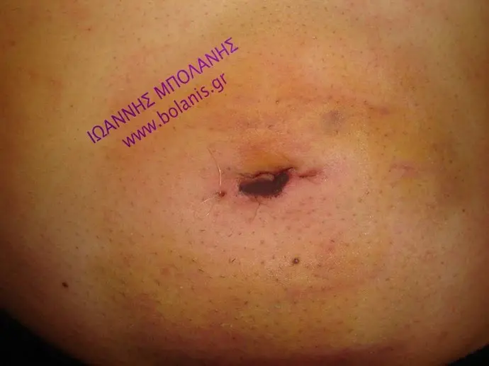 Hernia umbilical hernia inguinal hernia photos - khlh 1 1
