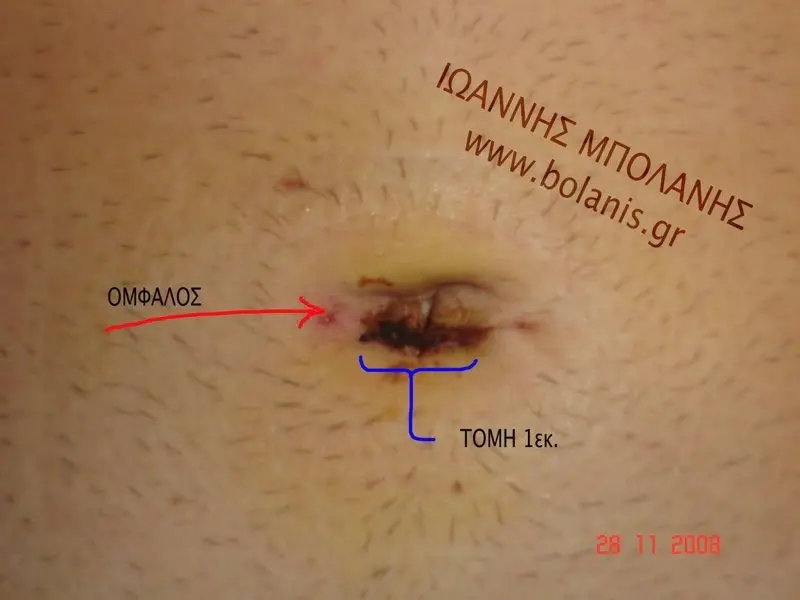 Hernia umbilical hernia inguinal hernia photos - khlh 2 1