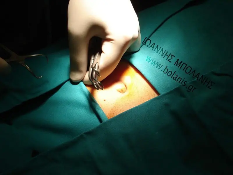 umbilical hernia