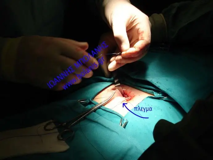Hernia umbilical hernia inguinal hernia photos - khlh 4 1