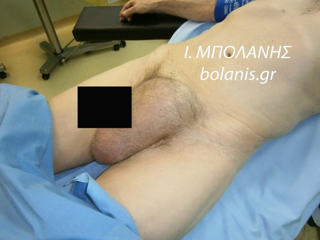 inguinal hernia