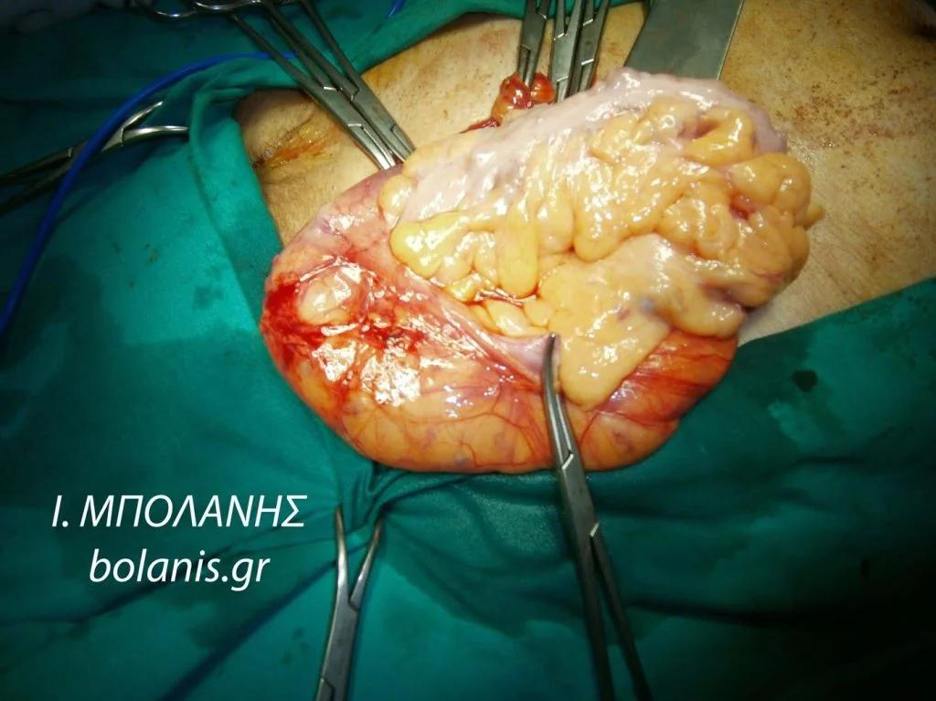 inguinal hernia with bowel contents