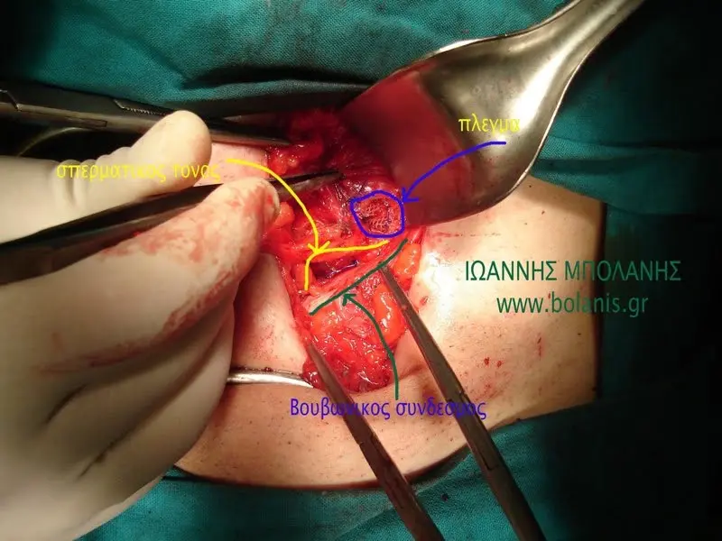 inguinal hernia after bowel repair