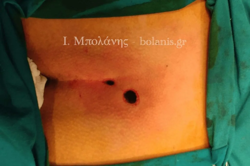 Κύστη κόκκυγος laser SiLaC - kisti 2