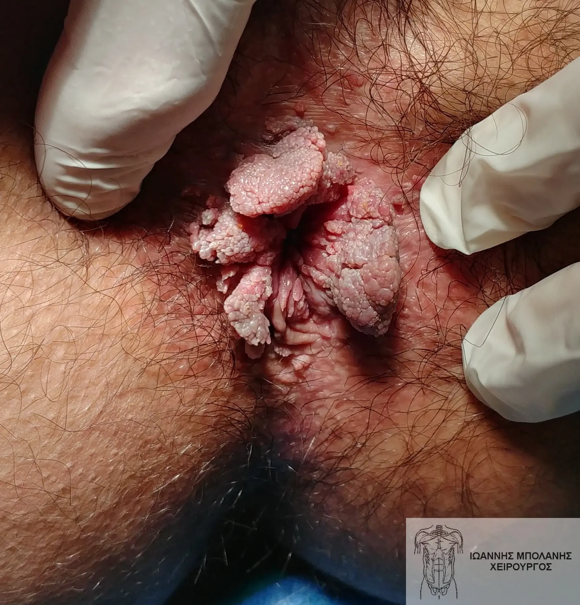 Perianal warts laser treatment