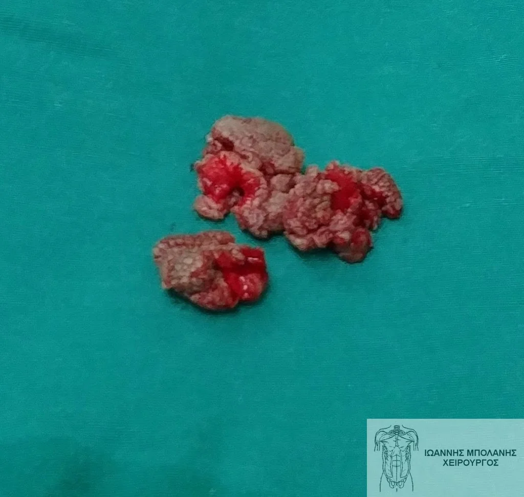 Large anal warts surgical removal and biopsy