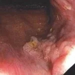 Colonoscopy anal warts