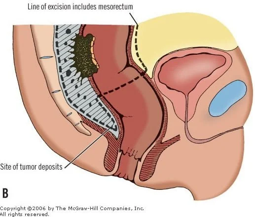 Rectal cancer the secrets of surgery