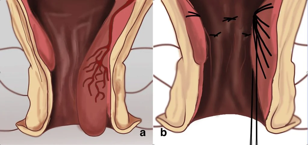 Hemorrhoids laser treatment - LHP® rar