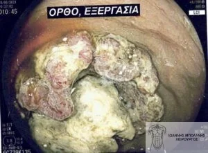 Rectal cancer without colostomy - rectal tumor 1
