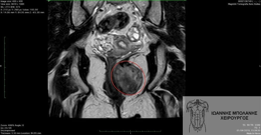 GIST pelvic tumor surgery - ogkos pyelou 1